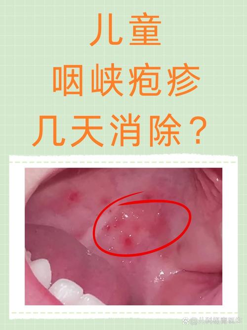 孩子高烧、咽痛……家长注意!夏季谨防疱疹性咽峡炎