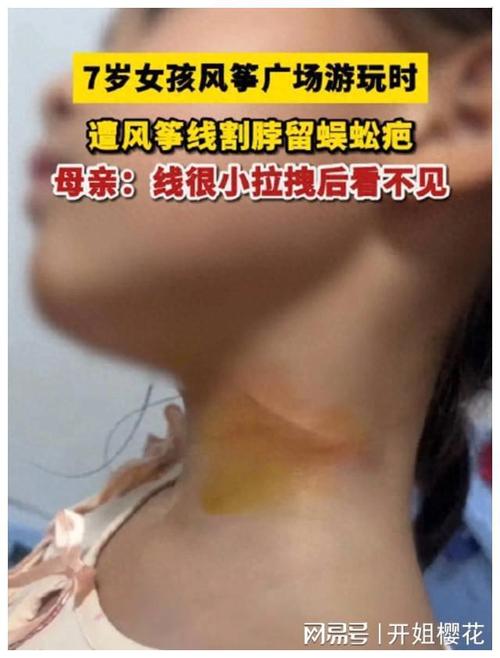 警惕!广东7岁女孩被割伤脖子!这东西太常见,近期千万注意
